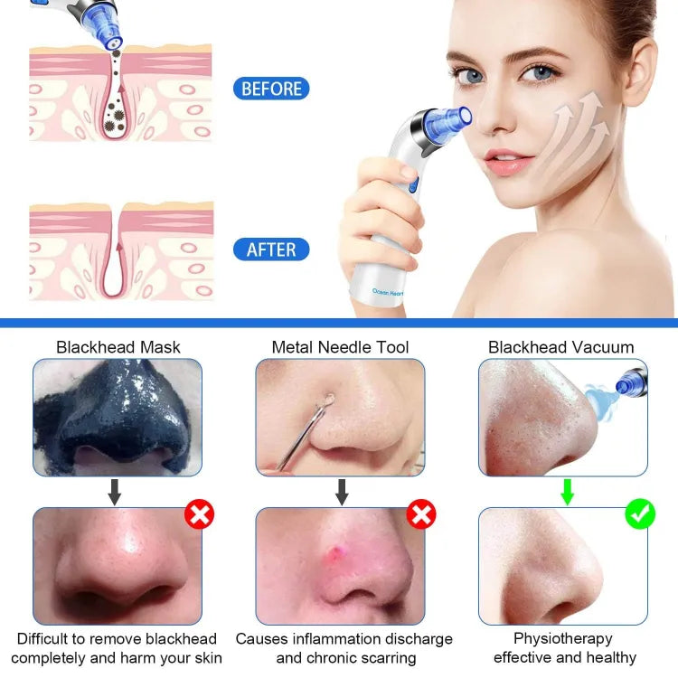 5-in-1 Blackhead Remover Tool: Deep Cleanse & Refine Pores for Glowing Skin